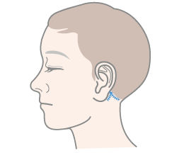 耳介背面の皮膚切除部分にマーキング