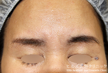 眉毛に左右差がある施術前