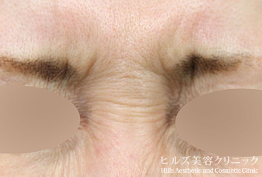 バニーライン1週間後