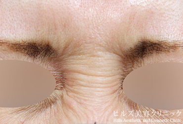 バニーライン施術前