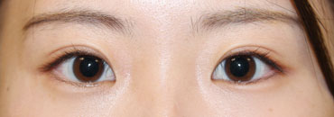 修正後8カ月後（初回～1年8カ月後）