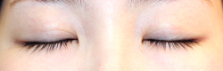 施術後5カ月閉瞼
