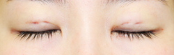 施術直後閉瞼