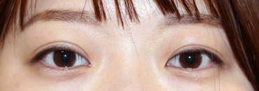 修正後約3週間（初回～5年4カ月後）