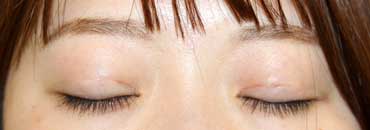 修正後約3週間（初回～5年4カ月後）