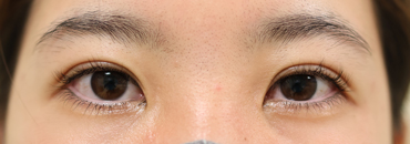 修正後1カ月（左側初回～4年4.5カ月後）