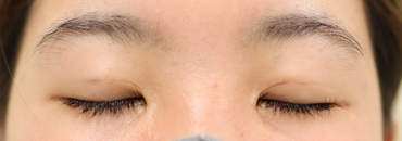 修正後1カ月（初回～4年4.5カ月後）