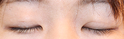 施術後2カ月半閉瞼