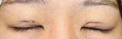 施術直後閉瞼