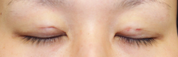 施術直後閉瞼