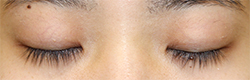 施術直後閉瞼