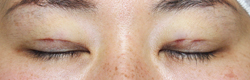 施術直後閉瞼
