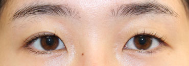 左まぶた修正前