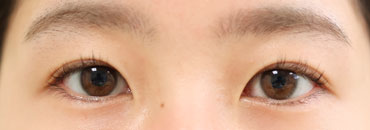 左まぶた修正1年5.5カ月後