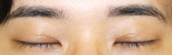 施術後1カ月後閉瞼