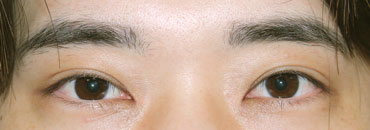 施術後1年9カ月後