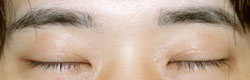 施術後7カ月後閉瞼