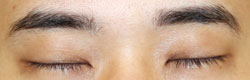 施術直後閉瞼