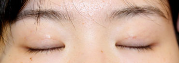 修正後1カ月（初回～1年6カ月後）