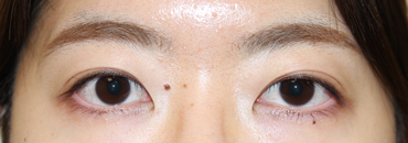 修正後1カ月（初回～4.5カ月後）