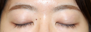 修正後1カ月（初回～4.5カ月後）