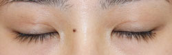 施術後1カ月後閉瞼