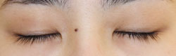施術直後閉瞼