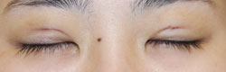 施術後2週間後閉瞼