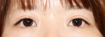 1カ月後（初回～2年後）