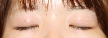 1カ月後（初回～2年後）