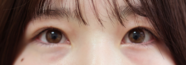 施術後7カ月後最大開瞼