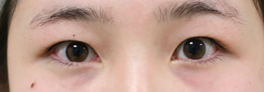 施術前最大開瞼