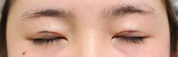 施術直後閉瞼