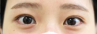 施術後1年9.5カ月後