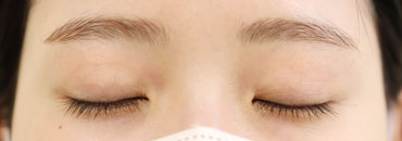 施術後1年9.5カ月後