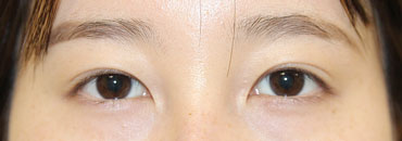 施術後4.5カ月後