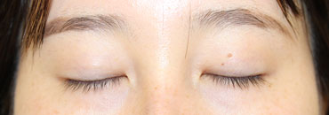 施術後4.5カ月後