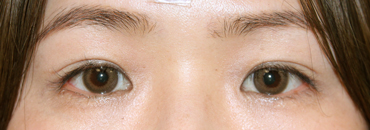 施術後5.5カ月後