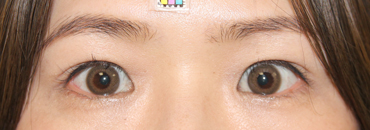 施術後5.5カ月後