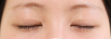 施術後1.5カ月後