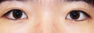 施術後6カ月半後