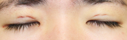 施術直後閉瞼