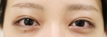 施術後2年7カ月後