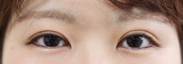 1カ月後（初回～3年7カ月後）