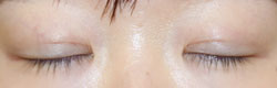 施術後1カ月後閉瞼