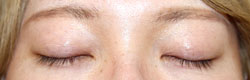 施術後直後閉瞼