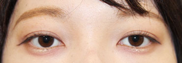 施術後6カ月半後