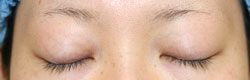 施術後1カ月後閉瞼