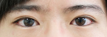 6年7.5カ月後（全切開施術2年6.5カ月後）