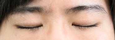 6年2.5カ月後（全切開施術2年6.5カ月後）